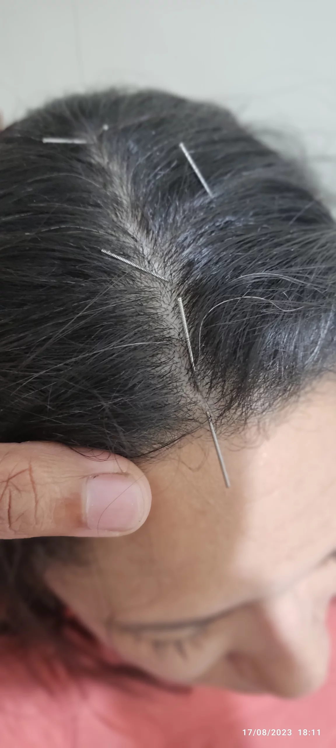 Acupuntura Craniana